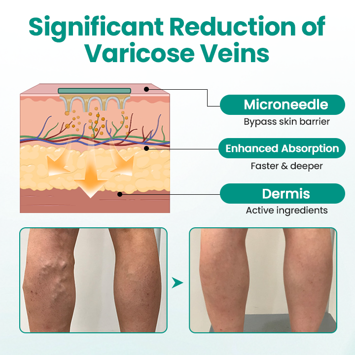 Timilk® LegRenew Varicose Veins Patch