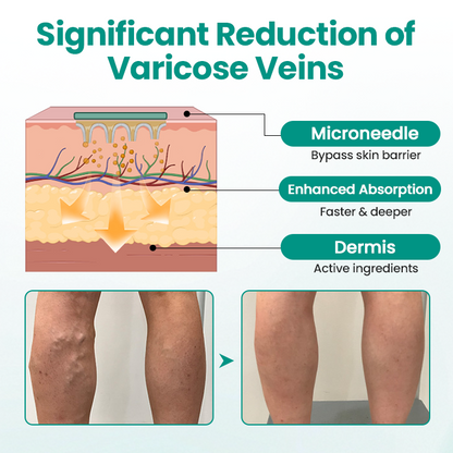 Timilk® LegRenew Varicose Veins Patch